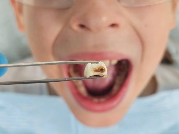 Best Emergency Tooth Extraction in Lee Acres, NM